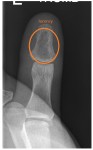 Left thumb distal phalanx osteomyelitis