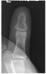 Left thumb frontal x-ray
