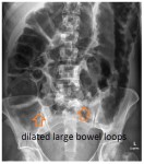dilated large bowel loops