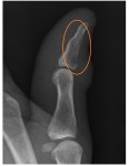 osteomyelitis distal phalanx left thumb