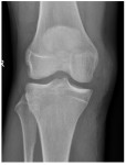 Frontal knee x-ray