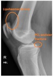 PCL avulsion fracture