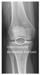intercondylar eminence fracture