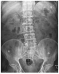 supine abdominal x-ray
