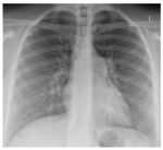 Frontal chest x-ray