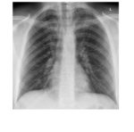 frontal chest x-ray