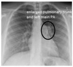 pulmonary stenosis cxr