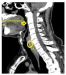 sagittal neck CT