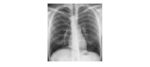 Erect chest x-ray