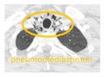 axial CT pneumomediastinum