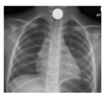 chest x-ray 1