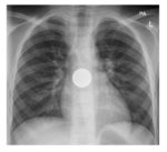 chest x-ray 2