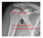 normal humeral head overlap