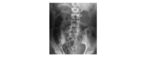 supine abdominal x-ray 1