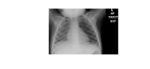 Expiratory chest x-ray