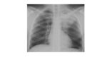 Frontal chest x-ray