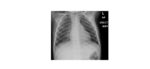 Inspiratory chest x-ray