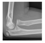 lateral elbow x-ray
