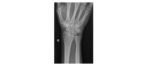 Right wrist x-ray frontal