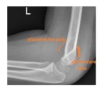 sail sign lateral elbow