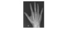 right-hand-x-ray