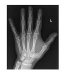 left-hand-x-ray