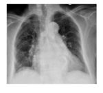 frontal-chest-x-ray
