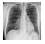 frontal-chest-xray