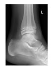 lateral-view-left-ankle