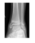 mortise-view-left-ankle