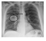 cavitating-pneumonia