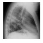 lateral-chest-x-ray