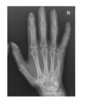 right-hand-x-ray