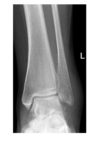 ankle-x-ray-ap-view