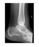 ankle-x-ray-lateral-view