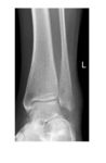 ankle-x-ray-mortise-view