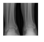 frontal-view-ankle