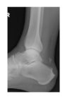 lateral-view-ankle