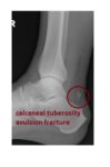 calcaneal-tuberosity-avulsion-fracture