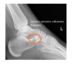 anterior-process-calcaneus-fracture