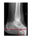 base-of-5th-metatarsal-fracture