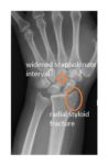 radial-styloid-fracture-with-scapholunate-disruption